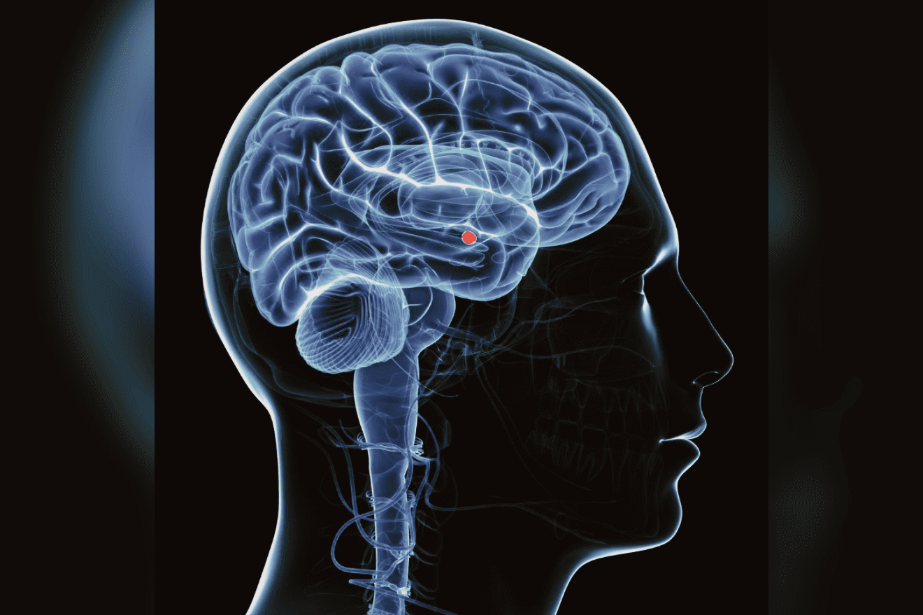 La amígdala cerebral, estructura fundamental en el procesamiento emocional, alterada en TEPT